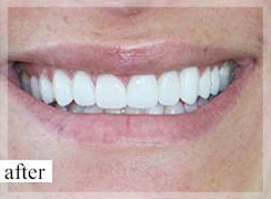 After Image: Smile Makeover - front