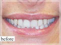 Before Image: Smile Makeover - front