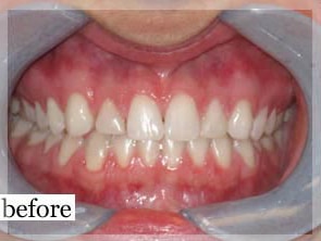 Before Image: Smile Makeover - front