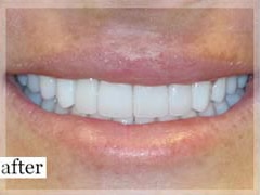 After Image: Smile Makeover - front