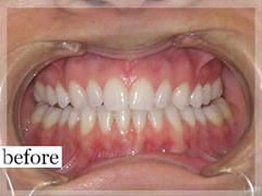 Before Image: Smile Makeover - front