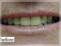 Before Image: Smile Makeover - front