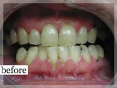 Before Image: Smile Makeover - front