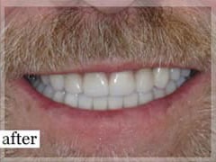 After Image: Smile Makeover - front