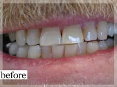 Before Image: Smile Makeover - front