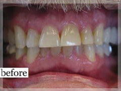 Before Image: Smile Makeover - front