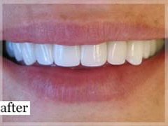 After Image: Smile Makeover - front