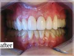 After Image: Smile Makeover - front