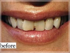 Before Image: Smile Makeover - front