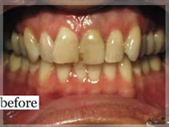 Before Image: Smile Makeover - front