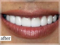 After Image: Smile Makeover - front