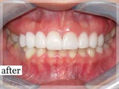 After Image: Smile Makeover - front