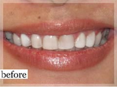 Before Image: Smile Makeover - front