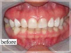 Before Image: Smile Makeover - front