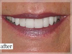 After Image: Smile Makeover - front