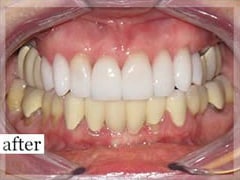 After Image: Smile Makeover - front