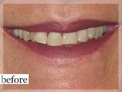 Before Image: Smile Makeover - front