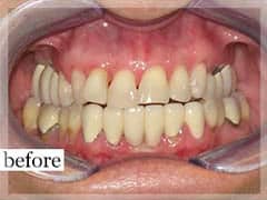 Before Image: Smile Makeover - front