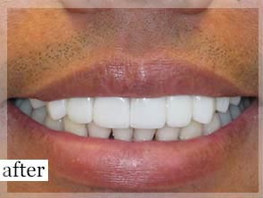 After Image: Smile Makeover - front