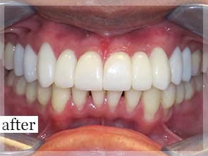 After Image: Smile Makeover - front