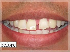 Before Image: Smile Makeover - front