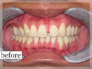 Before Image: Smile Makeover - front