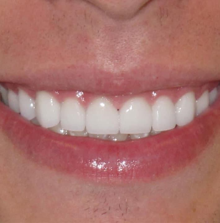 After Image: Smile Makeover - front