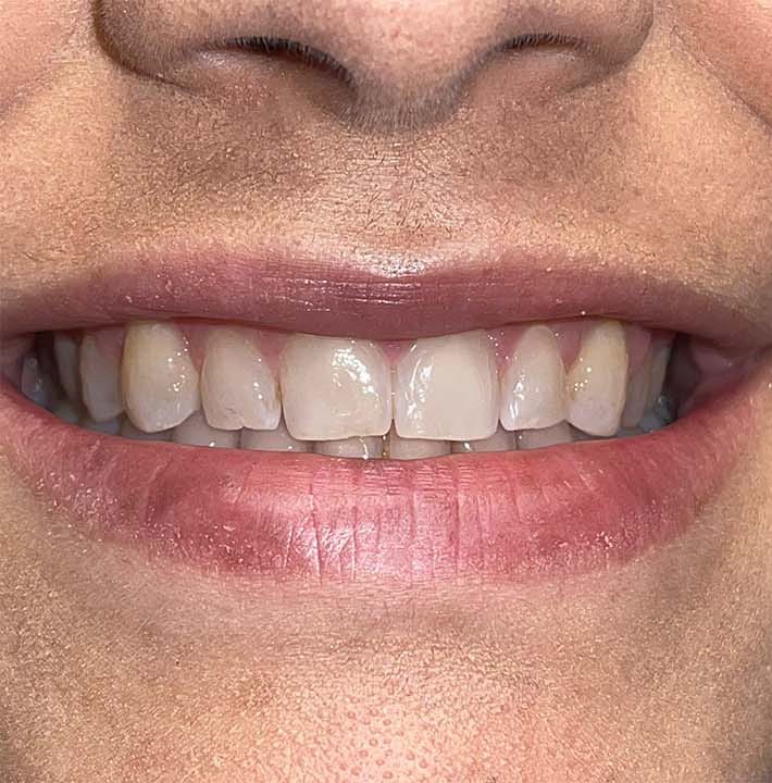 Before Image: Smile Makeover - front