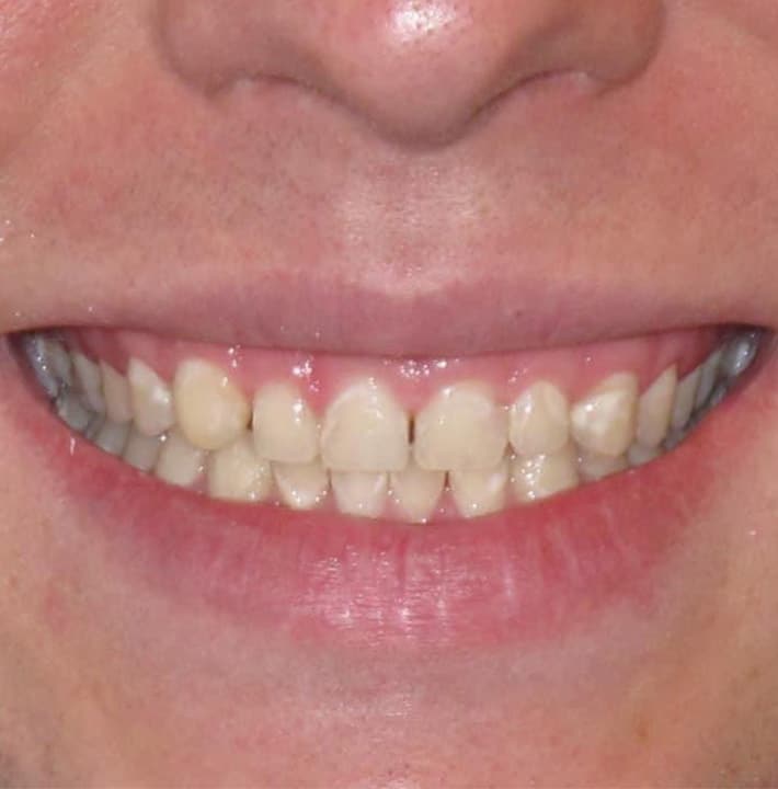 Before Image: Smile Makeover - front