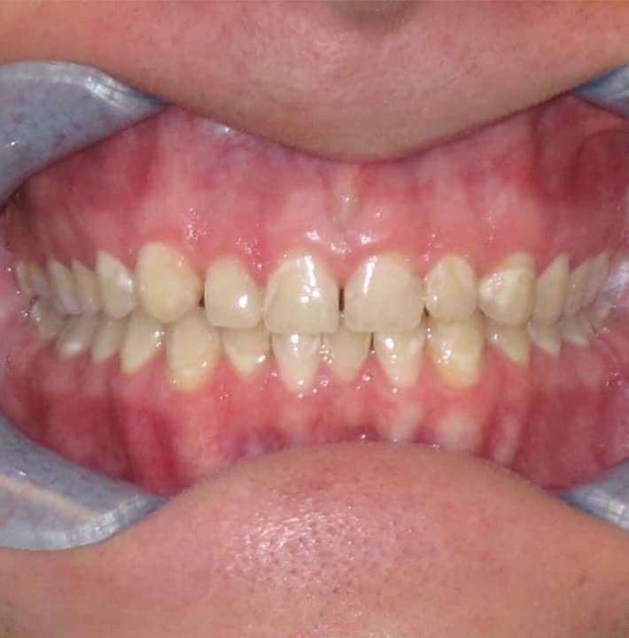 Before Image: Smile Makeover - front