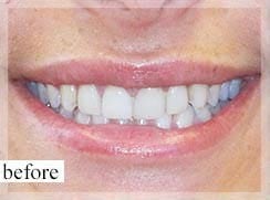 Before Image: Smile Makeover - front