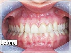 Before Image: Smile Makeover - front