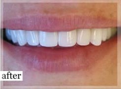 After Image: Smile Makeover - front