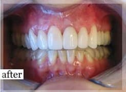 After Image: Smile Makeover - front