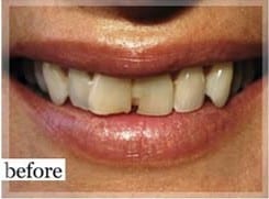 Before Image: Smile Makeover - front