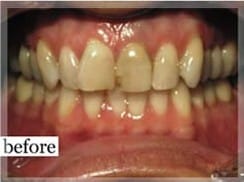 Before Image: Smile Makeover - front