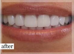 After Image: Smile Makeover - front