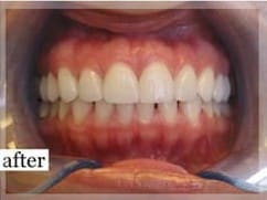 After Image: Smile Makeover - front