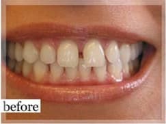 Before Image: Smile Makeover - front