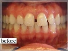 Before Image: Smile Makeover - front