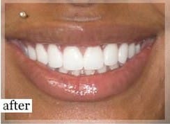 After Image: Smile Makeover - front