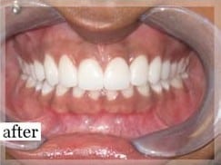 After Image: Smile Makeover - front