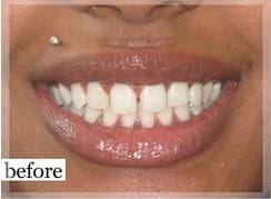 Before Image: Smile Makeover - front