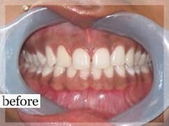 Before Image: Smile Makeover - front