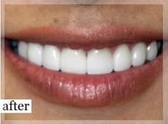 After Image: Smile Makeover - front