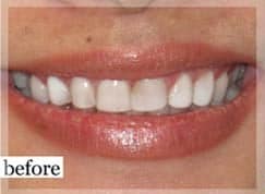 Before Image: Smile Makeover - front