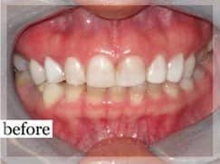 Before Image: Smile Makeover -