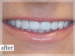 After Image: Smile Makeover - front