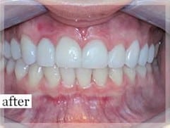 After Image: Smile Makeover - front