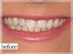 Before Image: Smile Makeover - front